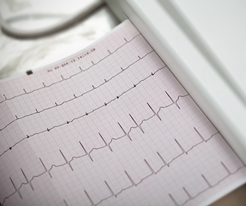 What You Need to Know About Causes & Treatment for Atrial Fibrillation