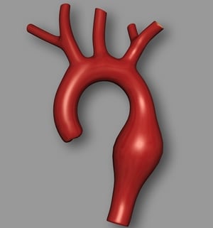 Should You Get Screened for an Aneurysm?