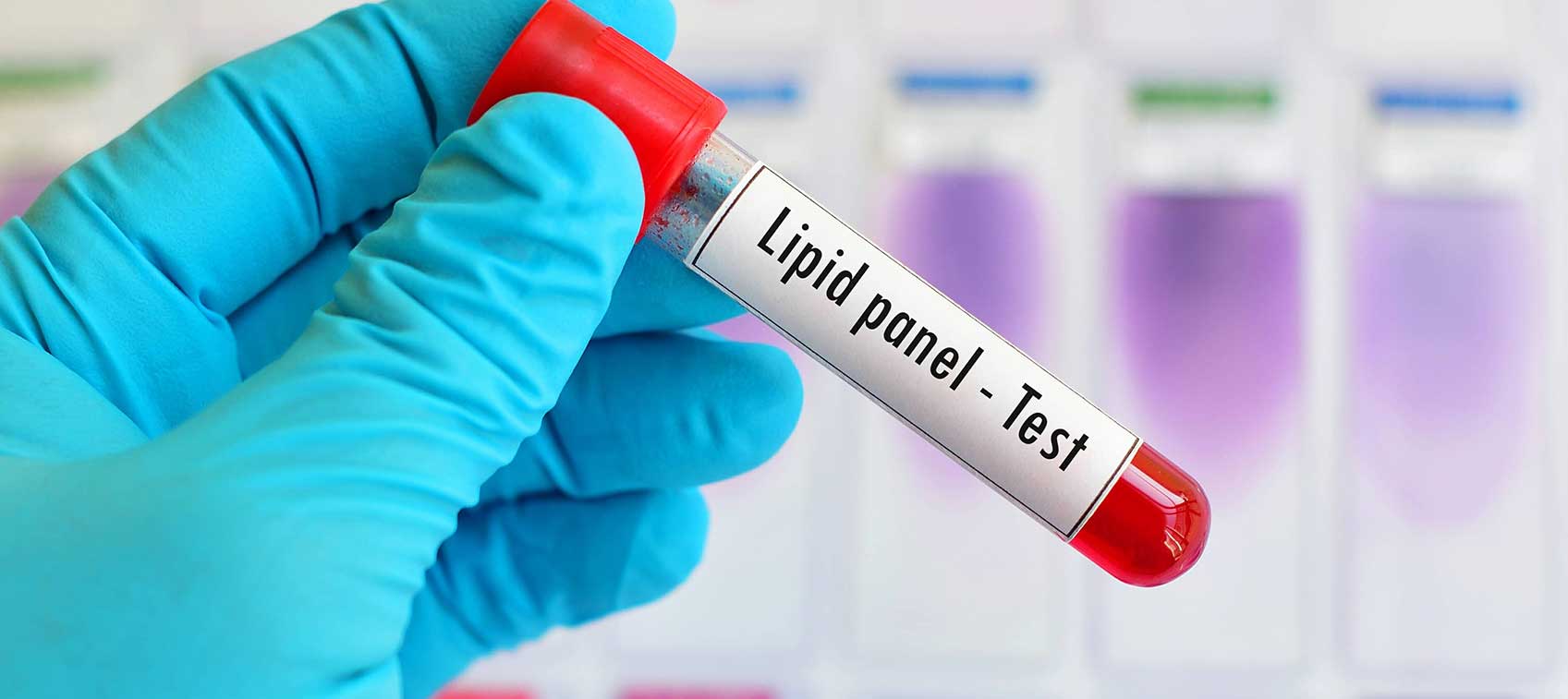 Beware of Elevated Lp(a) Cholesterol Levels