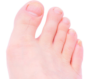 5 Ways To Tame Toenail Fungus Healthy Directions