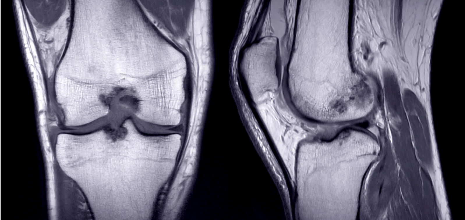 knee-cartilage-a-complete-overview-healthy-directions