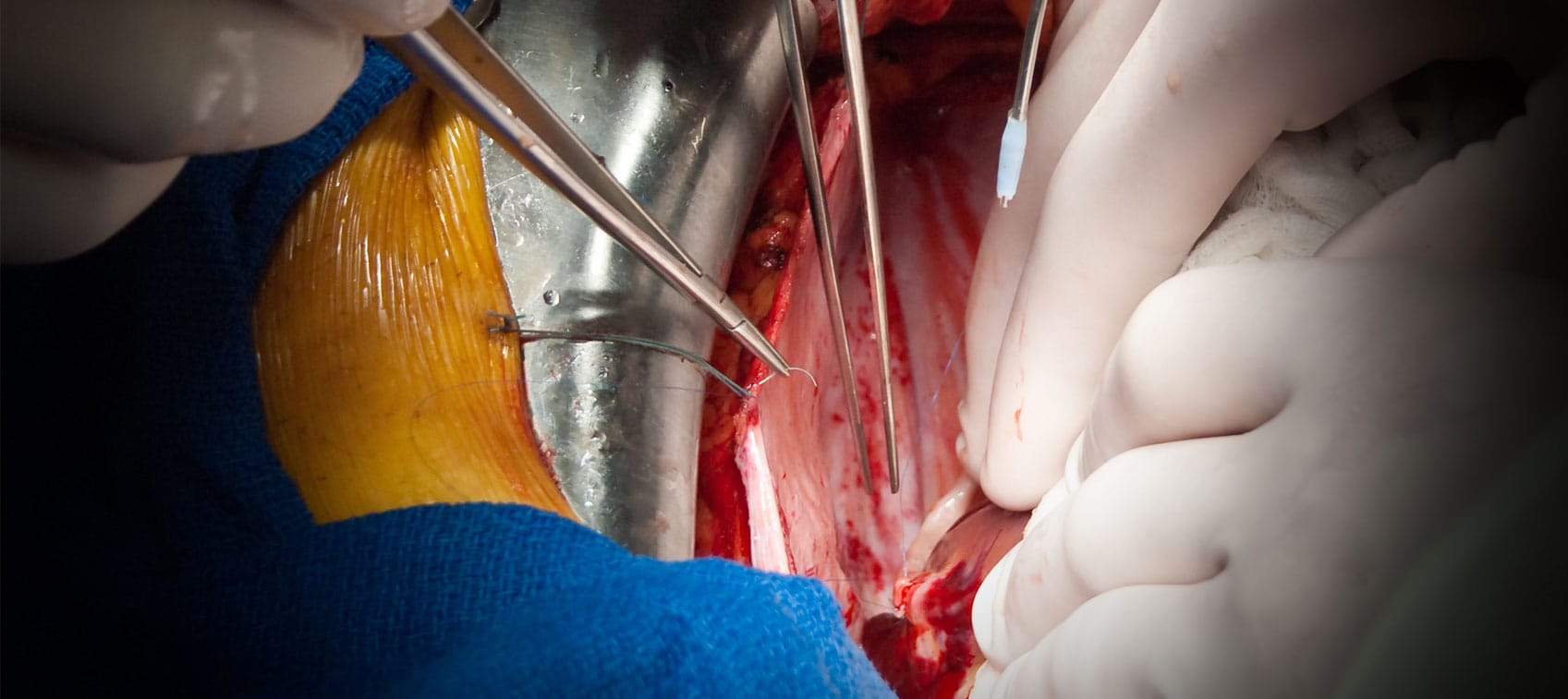 coronary artery bypass graft