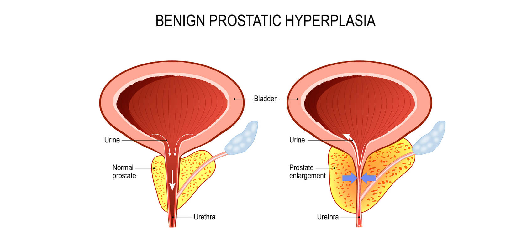 Benign Prostatic Hyperplasia Prevention And Treatment Healthy Directions