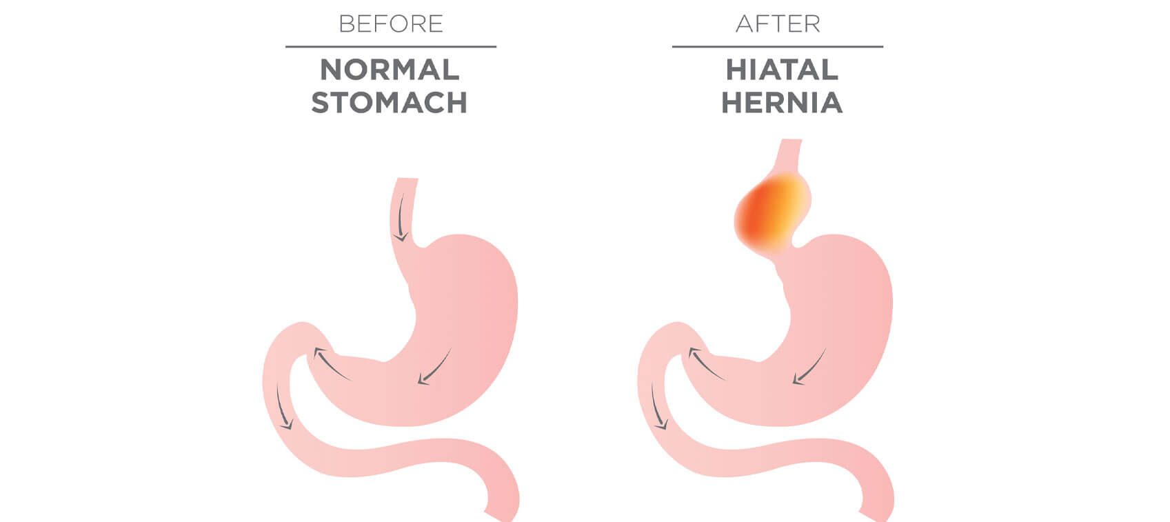 How to Fix a Hiatal Hernia Yourself