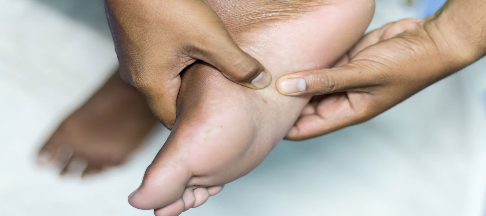 How to Treat Plantar Fasciitis